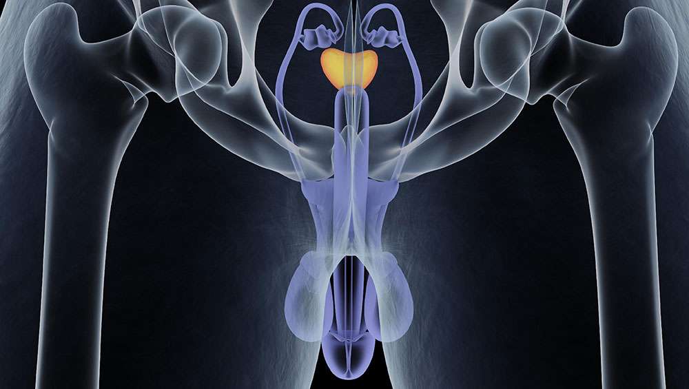 adenom de prostata